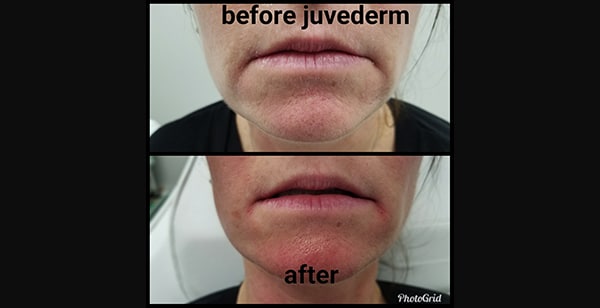 Injectables | Juvederm