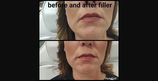 Juvederm | Injectables | Jena Ruxer